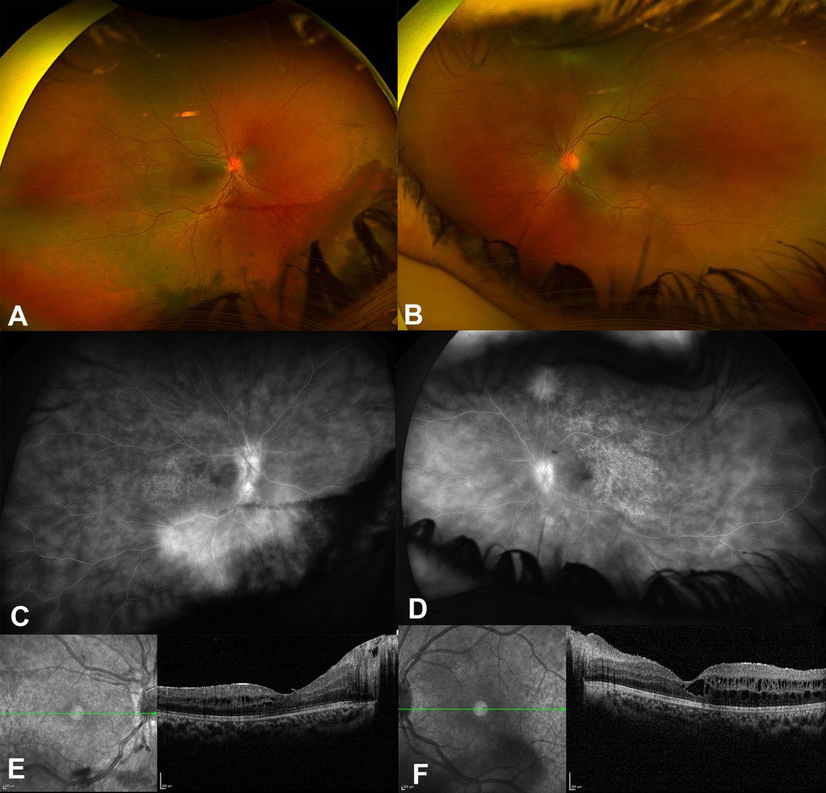 Ophthalmology tweet media