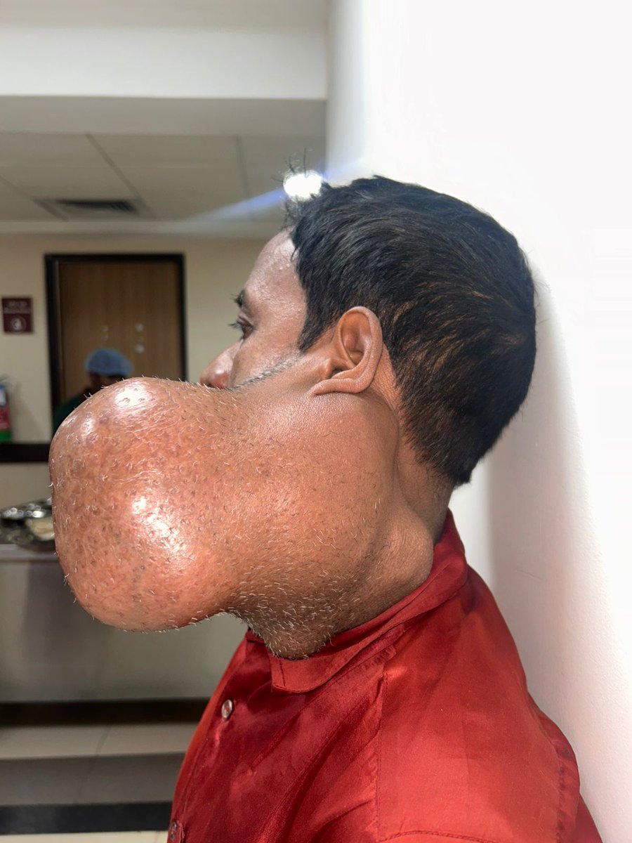aiims_gkp's tweet photo. A remarkable surgical achievement at All India Institute of Medical Sciences Gorakhpur 👏

The ENT Department, in collaboration with the Anesthesia Department, successfully performed a complex Radical Parotidectomy on a 53-year-old patient from West Champaran, Bihar, diagnosed with a massive pleomorphic adenoma of the parotid gland.

The patient had been suffering for years from a progressively enlarging swelling near the face and neck, leading to facial deformity and difficulty in daily life. After detailed clinical and radiological evaluation, the expert team successfully removed the tumor completely.

The excised tumor weighed approximately 1.8 kg, placing it among the extremely large parotid tumor cases reported.

This successful surgery reflects the advanced surgical expertise, multidisciplinary teamwork, and commitment to patient care at AIIMS Gorakhpur. #AIIMSGorakhpur #ENTSurgery #HealthcareExcellence #RadicalParotidectomy #PatientCare #MedicalSuccess @DrHeman26245445 @vibs1958 @JPNadda @myogiadityanath @mpprataprao @AnupriyaSPatel @CMOfficeUP @ravikishann @PIB_India @MoHFW_INDIA @PMOIndia