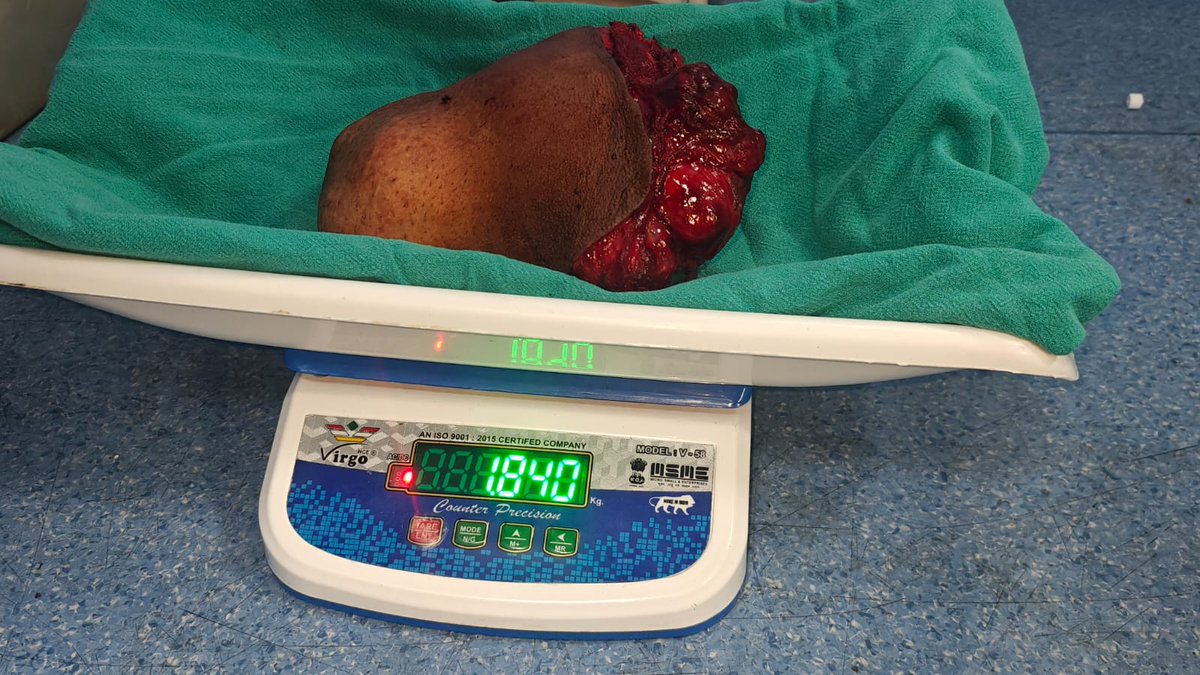 aiims_gkp's tweet photo. A remarkable surgical achievement at All India Institute of Medical Sciences Gorakhpur 👏

The ENT Department, in collaboration with the Anesthesia Department, successfully performed a complex Radical Parotidectomy on a 53-year-old patient from West Champaran, Bihar, diagnosed with a massive pleomorphic adenoma of the parotid gland.

The patient had been suffering for years from a progressively enlarging swelling near the face and neck, leading to facial deformity and difficulty in daily life. After detailed clinical and radiological evaluation, the expert team successfully removed the tumor completely.

The excised tumor weighed approximately 1.8 kg, placing it among the extremely large parotid tumor cases reported.

This successful surgery reflects the advanced surgical expertise, multidisciplinary teamwork, and commitment to patient care at AIIMS Gorakhpur. #AIIMSGorakhpur #ENTSurgery #HealthcareExcellence #RadicalParotidectomy #PatientCare #MedicalSuccess @DrHeman26245445 @vibs1958 @JPNadda @myogiadityanath @mpprataprao @AnupriyaSPatel @CMOfficeUP @ravikishann @PIB_India @MoHFW_INDIA @PMOIndia