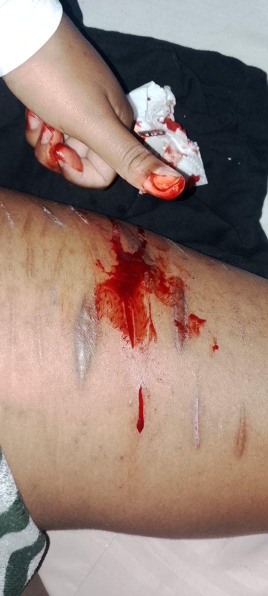 MaturanaSa24596's tweet photo. Pequeño corte en la pierna 

TODO FALSO, MAQUILLAJE

#SHEDTWT #goretwt #beantw #styrotwt #cutspo #scarpo https://t.co/8xN56rIYTp