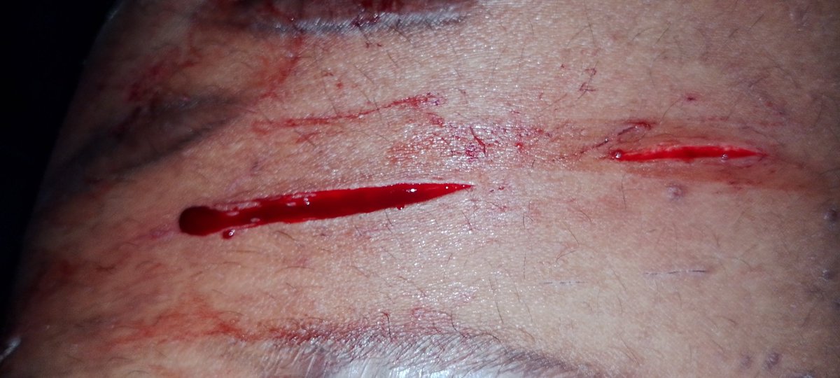 MaturanaSa24596's tweet photo. Pequeño corte en la pierna 

TODO FALSO, MAQUILLAJE

#SHEDTWT #goretwt #beantw #styrotwt #cutspo #scarpo https://t.co/8xN56rIYTp