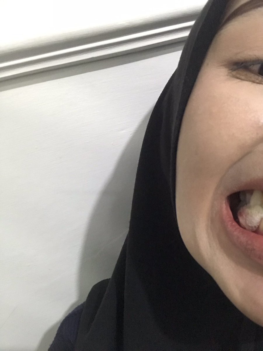 seterahlooo's tweet photo. @yappingfess Ak baru aja cbut gigi kmrin senin, case nya sma kyk gt cmn aku udh nekrosis mahkotanya hbis dn abses yg ga kunjung smbuh udh mau 2thn. jd ak beraniin cabutt krna gbisa di petahanin. ak di klinik nderr, untuk perawatan abses kontrol pertama harganya 45rb dpt antibiotik, lanjut- https://t.co/2eKpRFklgI