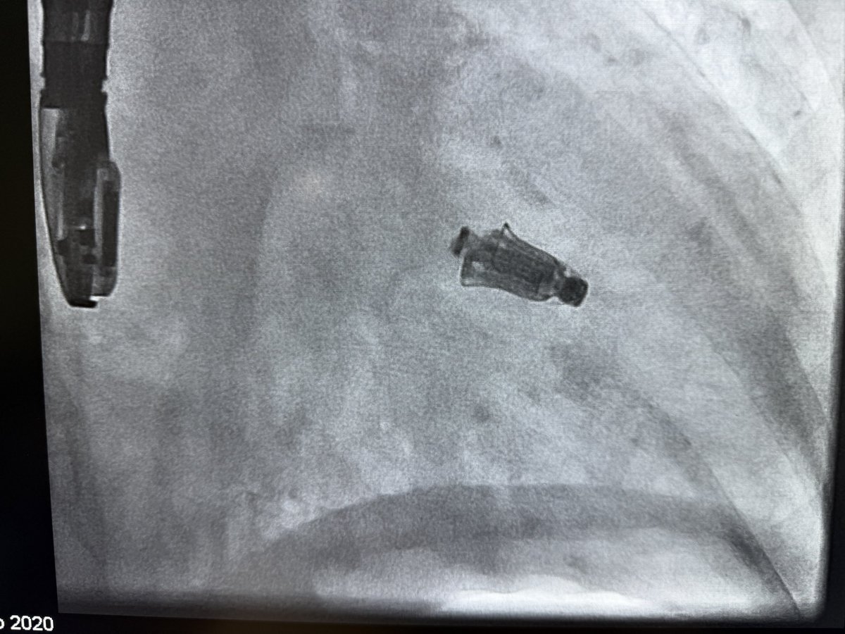 MosaAbbadi1's tweet photo. 84-year-old 👩🏻 presented with severe symptomatic MR, NYHA Class III, and recurrent decompensated heart failure with 3 hospitalizations within the last 6 months. The anatomy was complex for M-TEER, with CLI and a relatively small mitral valve area (~4.10 cm²), creating a very narrow margin between achieving adequate MR reduction and avoiding significant mitral stenosis. Position the PASCAL ACE device was challenging we couldn’t reduce MR by positioning the device central to medial but when we positioned the device more lateral, we achieved an excellent final outcome: • MR reduced from severe to trivial • Final mean transmitral gradient of only 3 mmHg at HR 80 bpm