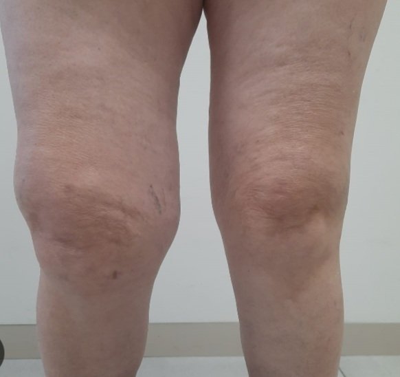 MarcoChangoS's tweet photo. ARTROSIS Y DOLOR CRÓNICO DE RODILLA 
MEDEPORT 
Dr. Marco Chango Médico Deportólogo especializado en la UFRGS Brasil, IMD de la Habana Cuba y CAR de Barcelona España.
Monte Sinai Torre 2 4to piso Cuenca 
WhatsApp 0987302477 https://t.co/8Fz8OrlqeT