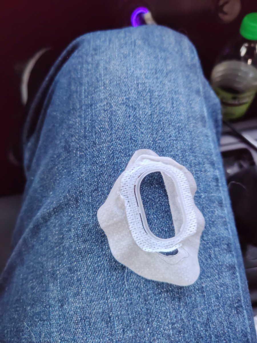 ChilangoAlfa's tweet photo. @SibionicsCGM Tu parche extra del sensor solo duró un día 🫩 https://t.co/SLTg6KDZ5U