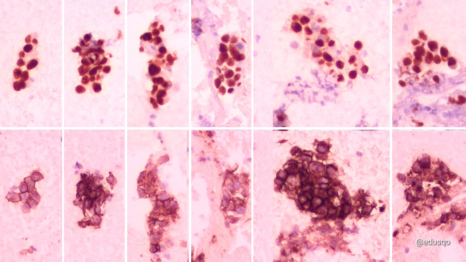 edusqo's tweet photo. I am a pathologist and a cytopathologist and I love solving diagnostic puzzles. In this case, a FNA #CellBlock with a metastatic squamous cell carcinoma. PDL1 was difficult to evaluate due to the scarce sample. Isolated nests. 2 slides, Z-stacking p40-PDL1 😀
#FNAFriday #CytoPath https://t.co/XNO7vK7XQg