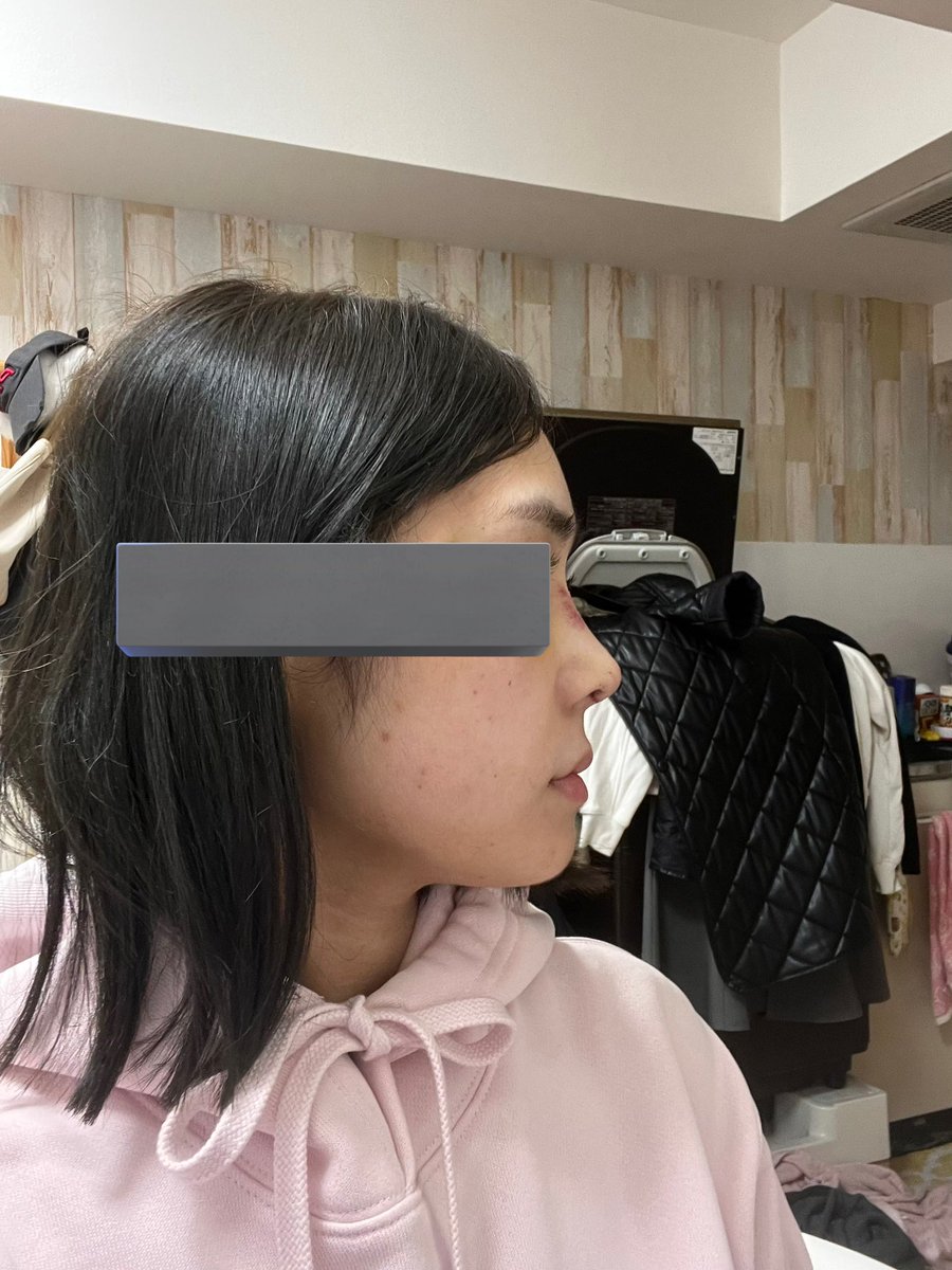 yz5bnfea_'s tweet photo. アウラ美容整形外科
執刀医:チュ先生(ネ申)

鼻フルDT3ヶ月꜀^. ̫.^꜆
術後のツン鼻も気に入ってたけど、今の鼻もいい感じに馴染んで好き😚🤍
プロテ入れるか迷ったけど、私は入れなくて正解の顔だったかもな
にしても術前の陥没具合おもろい

1枚目:術前
2枚目:術後1週間
3.4枚目:術後3ヶ月 https://t.co/qVP8B8LpHO
