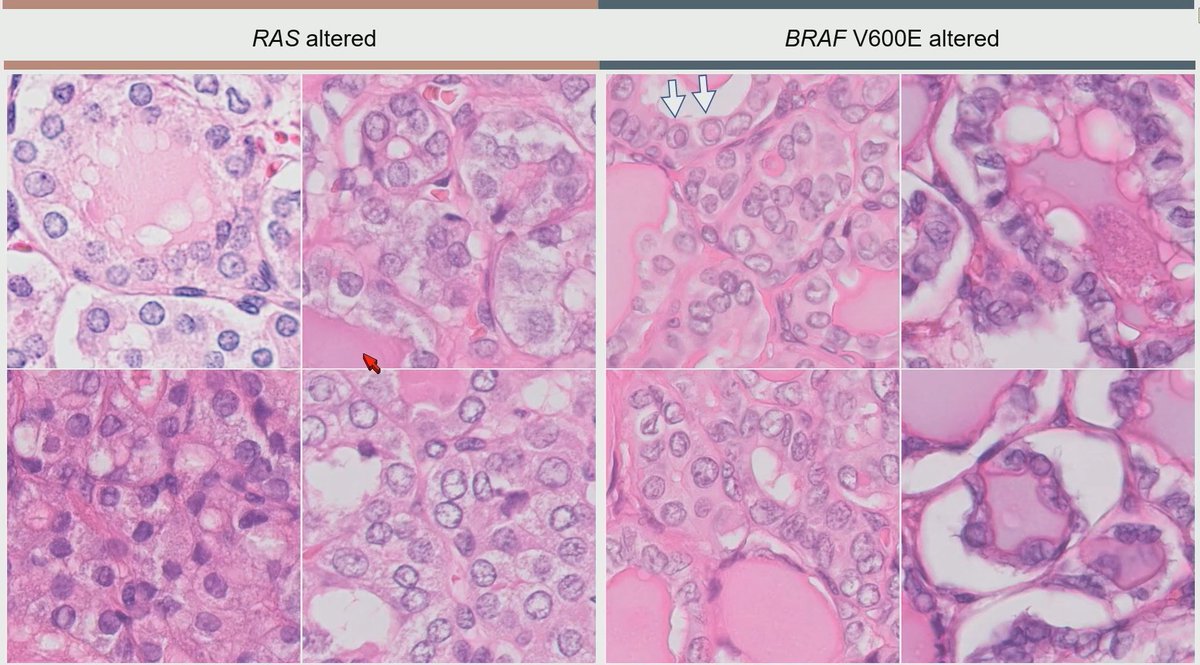 Janiranavarro's tweet photo. Thyroid
RAS-like: The follicular family
BRAF-like: The papillary family

Dr. Jung  #USCAP2026 #pathology #PathX #PathTwitter https://t.co/rj2H0k9K4D
