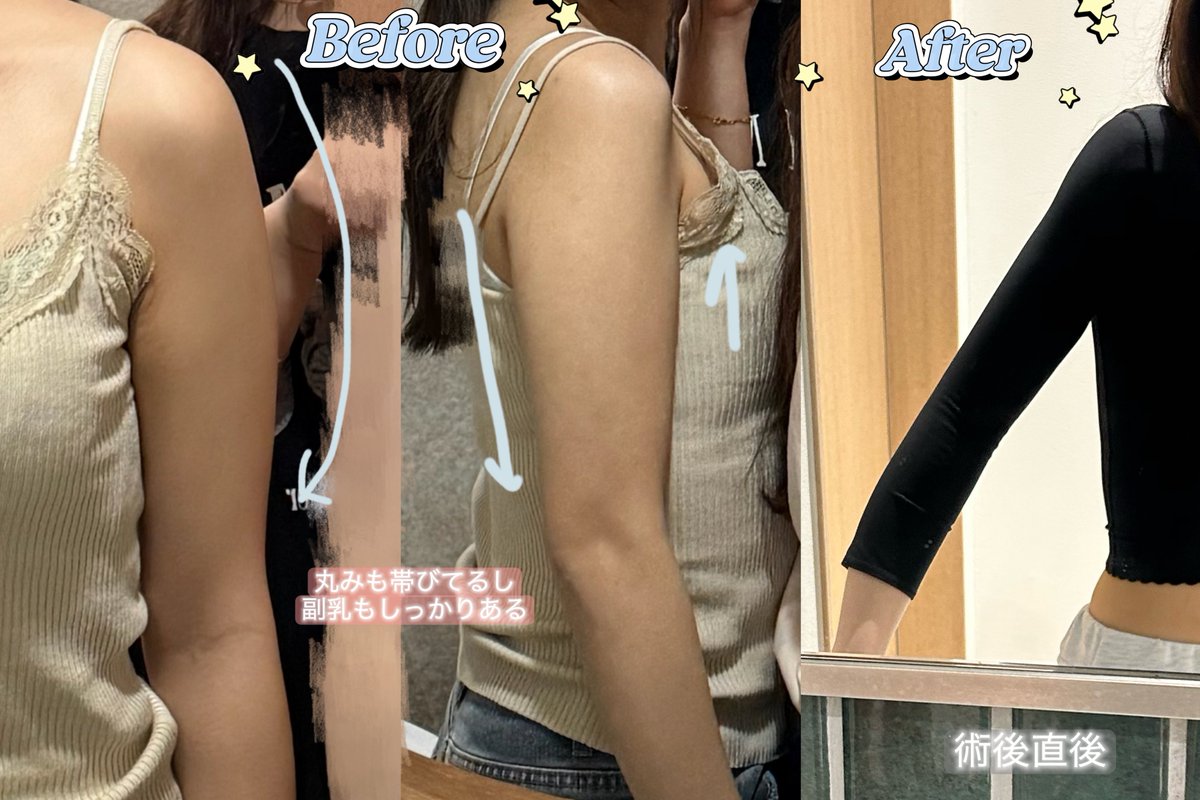 msarang_'s tweet photo. 📍ディライト整形外科
念願の二の腕脂肪吸引をしてきました🤍

💬なぜディライトにしたか
【とにかくカリカリ希望！】
トップライン式・症例がカリカリかつ凄く綺麗で見た瞬間絶対ここでやりたい❗️て思った🥺

【抜糸不要・傷口が小さい】
De:MIS縫合法・傷口はピンセットの先ぐらい小さい

⬇️経過レポ https://t.co/qunlDo1ZZC