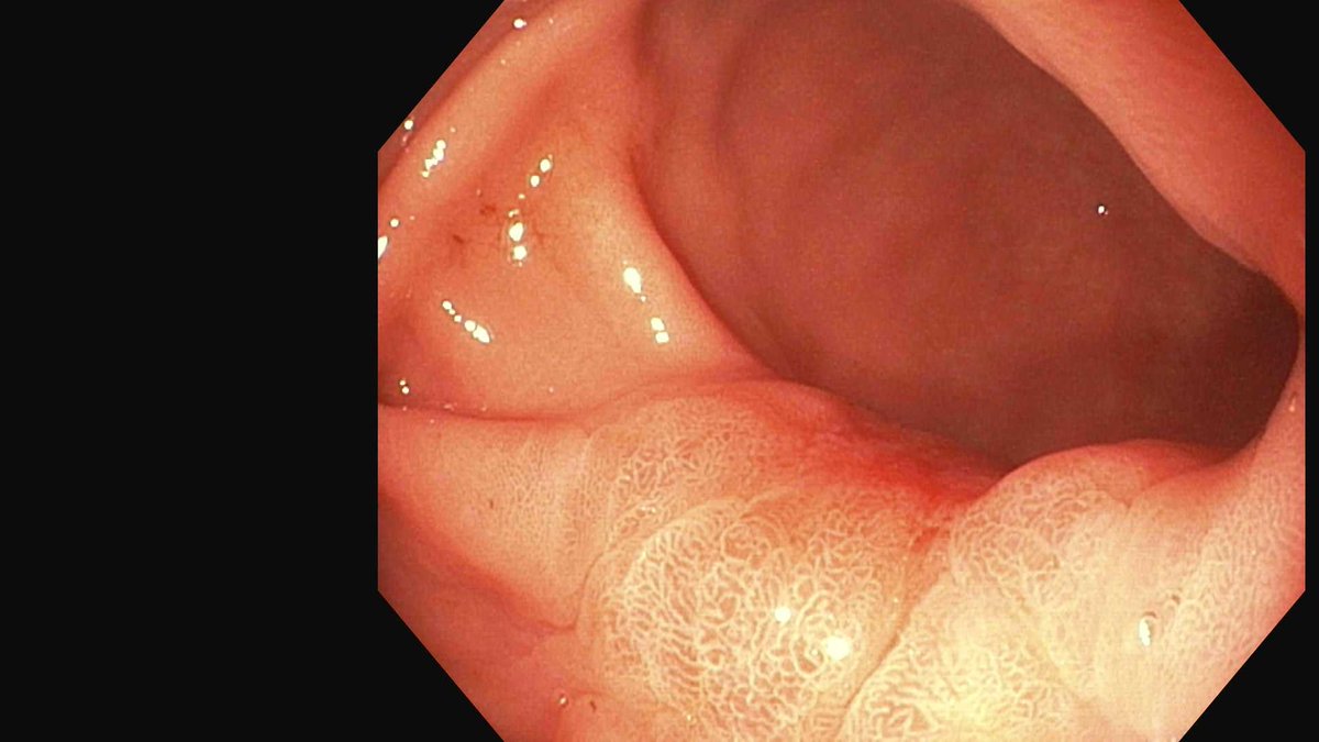 DouglasAdlerMD's tweet photo. Gastric cancer found incidentally during an EGD for GERD. Literally seconds before this was noted I was commenting to the trainee how even the most routine endoscopic procedures can yield critical discoveries! #gitwitter @Stentingwoman @EUSandEndoscopy @DavidDiehlMD @ibddoc09 https://t.co/mU4LKgVAS8