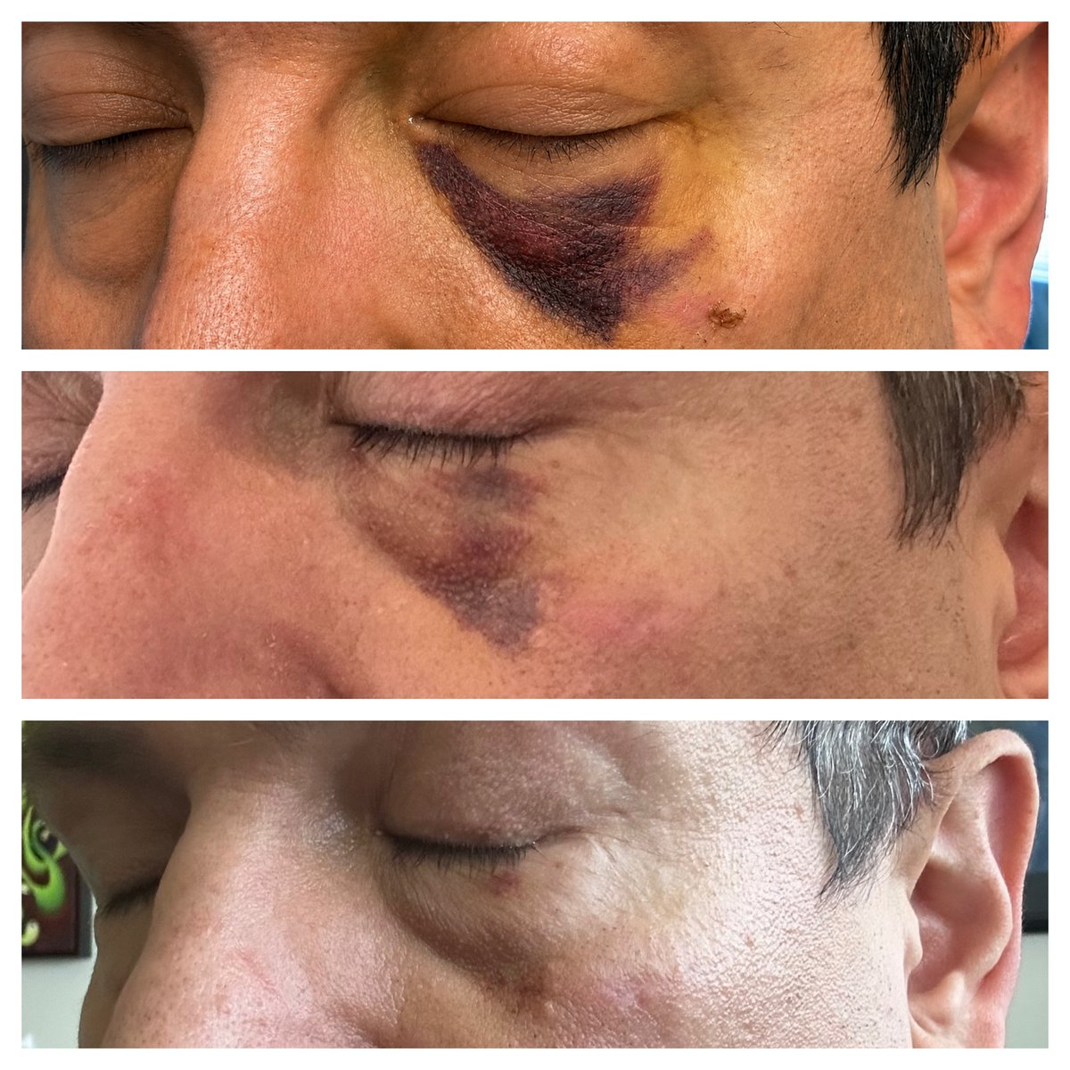 Dermaka's tweet photo. Day 1 to Day 3 progress using Dermaka® Cream after a facial bruise.

This individual applied Dermaka Cream consistently during recovery to help support the appearance of bruising and skin discoloration. #dermaka #dermatology #skincare #skinhealth https://t.co/fwhb6viNxv