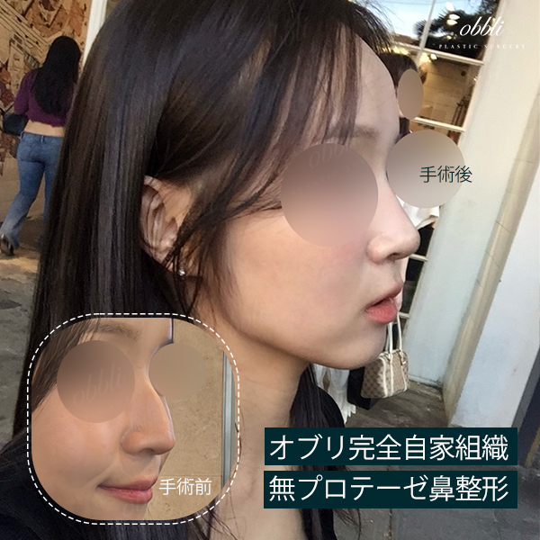 obblips's tweet photo. オブリ整形外科鼻整形症例
▶完全自家組織無プロテーゼ鼻整形

オブリでは『無プロテーゼ』
『自家組織のみ』で鼻整形可能🫶🏻

お問い合わせは公式LINEまで
お気軽にご連絡ください🩷
📩 https://t.co/efETLyTkwB

#韓国整形 #鼻整形 #鼻フル #整形垢 #渡韓 #カウンセリング #整形 #整形垢と繋がりたい https://t.co/84r23xrMGc