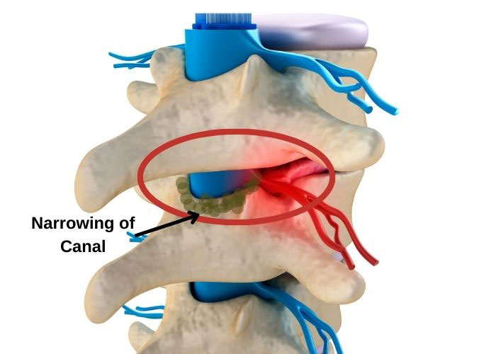 AndreSamuelMD's tweet photo. Leg heaviness/cramping after walking, relieved by flexion. Initially “deconditioning.” MRI: #lumbarstenosis. 

After failed conservative care → decompression. Marked functional improvement. Key: diagnosis is clinical pattern recognition, not MRI alone. https://t.co/M4Qk7JzJsV https://t.co/MUG9LNoi26