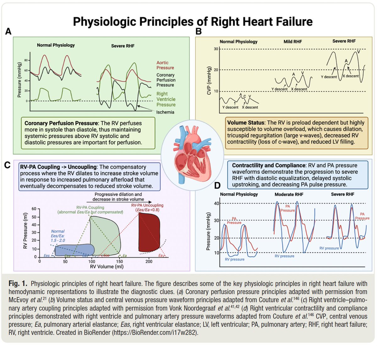 CODonnell1130's tweet photo. Happy to share our latest publication:
Defining Perioperative Right Heart Failure in Cardiac... : Anesthesiology 

@sunlouise1 @stanfordanes @_Anesthesiology 
https://t.co/rgFIADTwtB https://t.co/jIBGeS4CkG