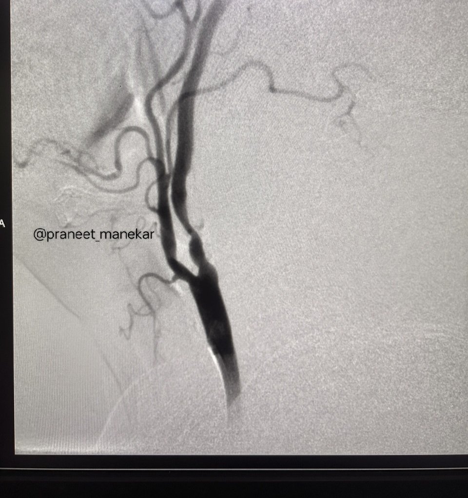 praneet_manekar's tweet photo. Carotid Artery Stenting with embolic protection device #SpiderFX
#PeripheralIntervention #Cardiology #CarotidStenting https://t.co/5gznbZdOKL