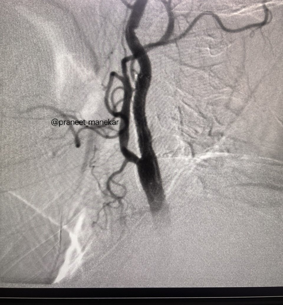 praneet_manekar's tweet photo. Carotid Artery Stenting with embolic protection device #SpiderFX
#PeripheralIntervention #Cardiology #CarotidStenting https://t.co/5gznbZdOKL