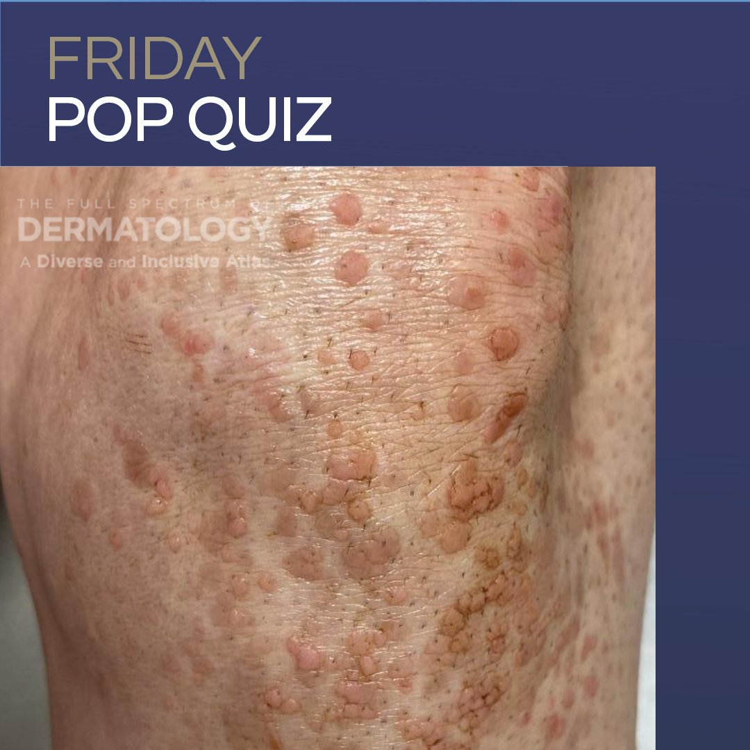 NextSteps_Derm's tweet photo. Friday brain exercise: active! Can you nail this week’s board review question or is it a total curveball?

Drop your answer in the replies, then head to Next Steps in Derm to see the full breakdown and the correct choice! 👇

🔗https://t.co/Rf7Kso6GP8 

#DermTwitter #BoardReview https://t.co/Rq3fWla0ea