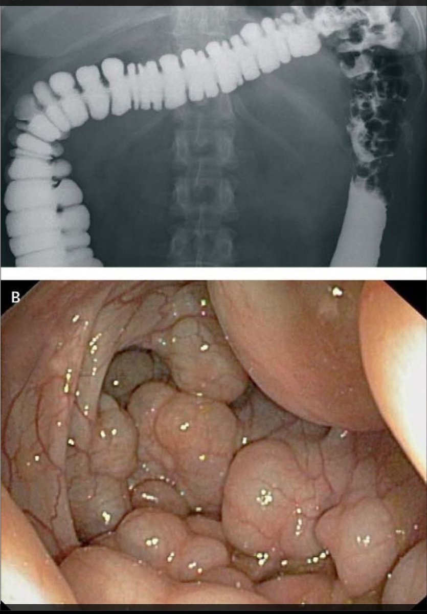 GastroIssu96098's tweet photo. Pneumatosis coli https://t.co/upnE7ub7k6