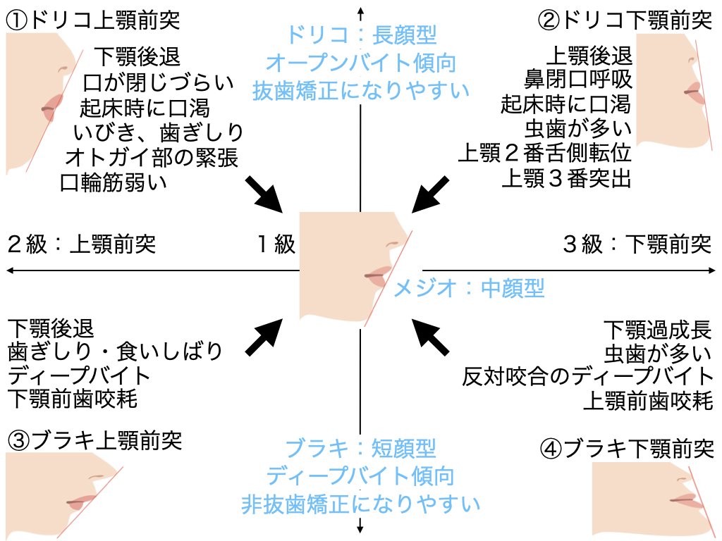 人間の顎顔面のタイプごとに特徴があります。 それぞれわりと典型的