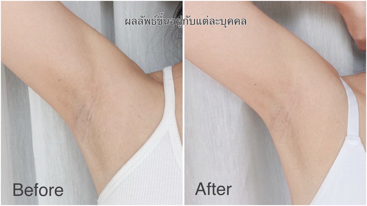 sabaisri's tweet photo. กล้าโชว์วงแขนได้อย่างมั่นใจมากขึ้น ก็เพราะ NIVEA Derma Control Defend ตัวนี้เลย!! จากเดิมที่วงแขนคล้ำๆหน่อย ตอนนี้เรียบเนียนมากขึ้น ✨  จากเดิมก็คือเหี่ยวๆ เป็นเส้นๆ ตัวนี้เขามี Micro Hyaluron + Vitamin B5 💙 ช่วยให้น้องจั๊กของเราเรียบเนียนขึ้น แถมไม่เหนียวเหนอะหนะ กลิ่นหอมสะอาดๆ 🫧แถมแห้งไว ใครที่ไม่มั่นใจในวงแขนต้องมี!! 🥰