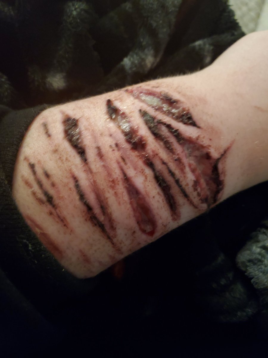 Apotelesma38's tweet photo. @callmekunii nothing compared to some of these 😨 but whatever
The last ones scars were beans mostly
The scab was a baby bean or deep styro
I don't remember even though that was a week ago 😒 https://t.co/VdugC7qxlM