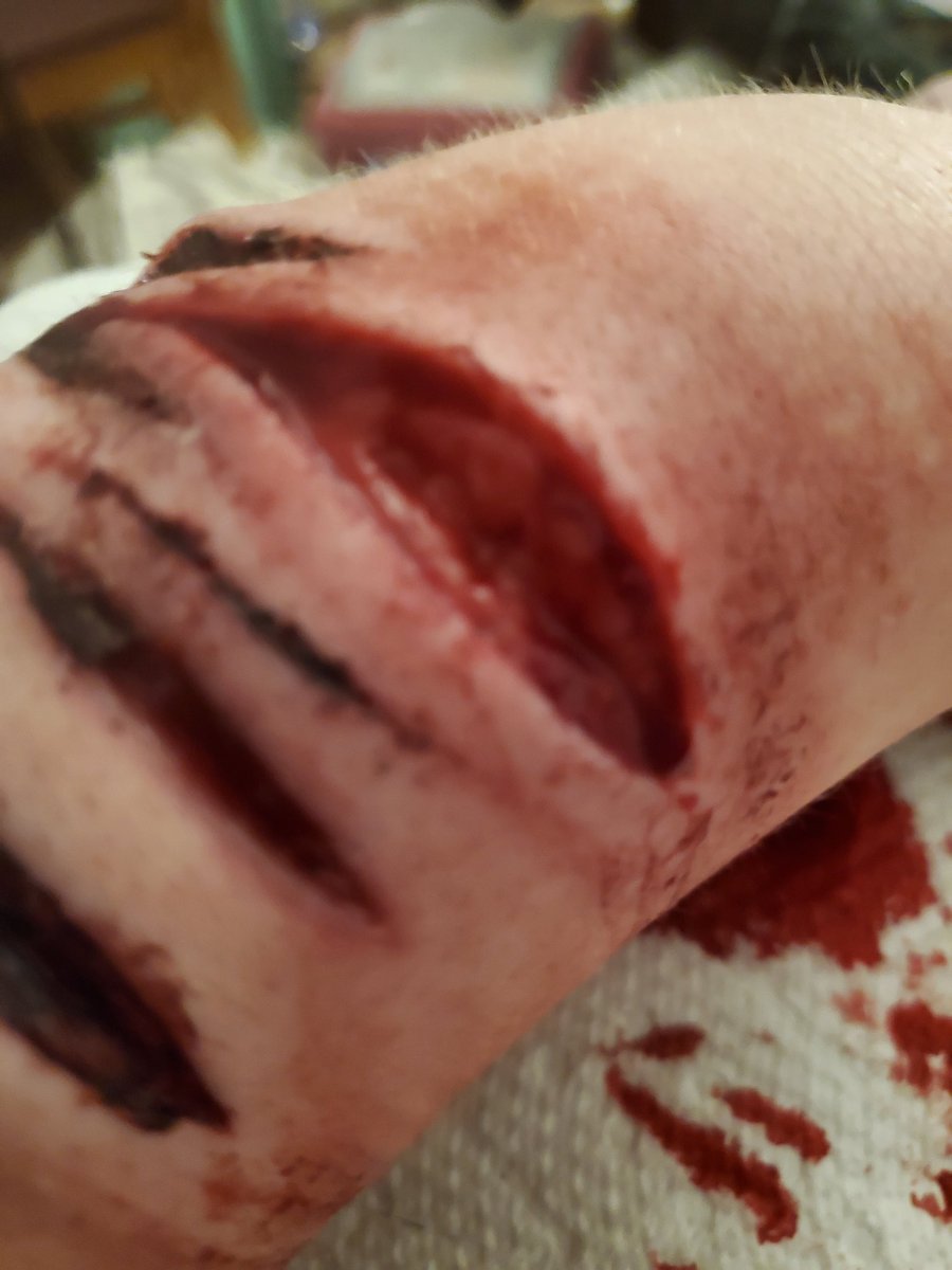 Apotelesma38's tweet photo. @callmekunii nothing compared to some of these 😨 but whatever
The last ones scars were beans mostly
The scab was a baby bean or deep styro
I don't remember even though that was a week ago 😒 https://t.co/VdugC7qxlM