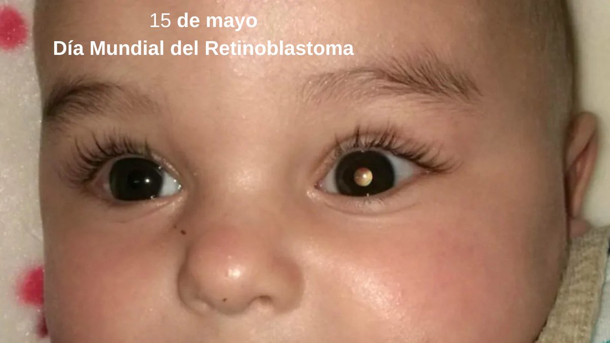 iluminafrica's tweet photo. Apoyamos el #DiaMundialDelRetinoblastoma 
#SemanaMundialDelRetinoblastoma #DiaDelRetinoblastoma
Web 🌐  @_AER_es
https://t.co/woCqJJGxMZ
Articulo 📰 de @RadioPopular
https://t.co/x4RG0fAxZJ https://t.co/mjl4sRzeWl