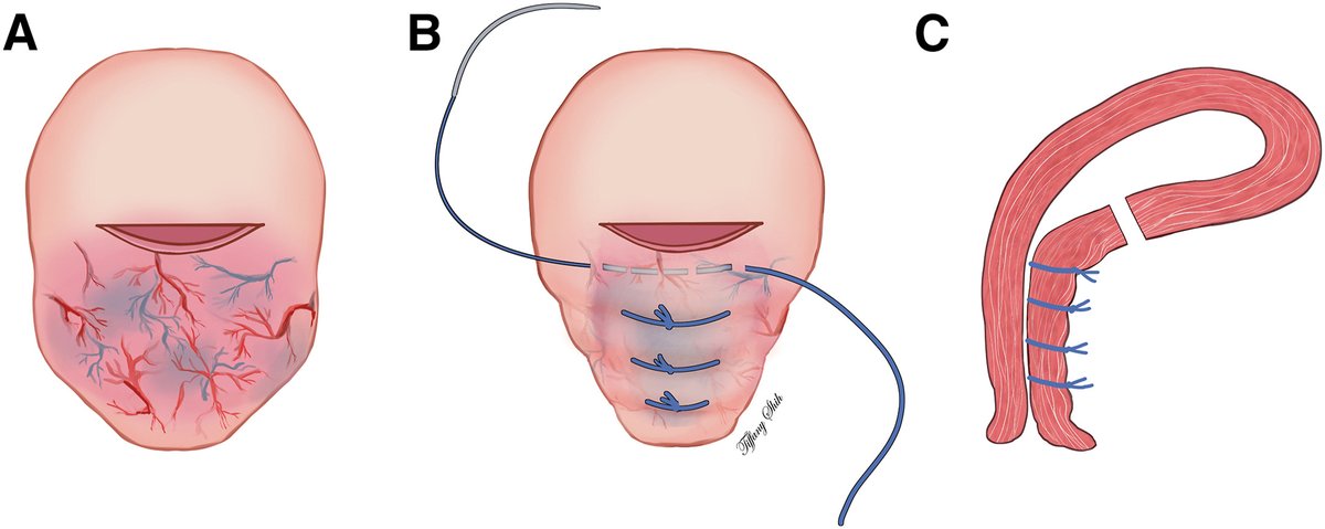 AJOG_thegray's tweet photo. AJOG Expert Review in Cesarean: The Nausicaä suture in the management of the placenta accreta spectrum - The technical aspect of the Nausicaä suture https://t.co/ynYeiuWYkI https://t.co/wA6fgYRwvJ