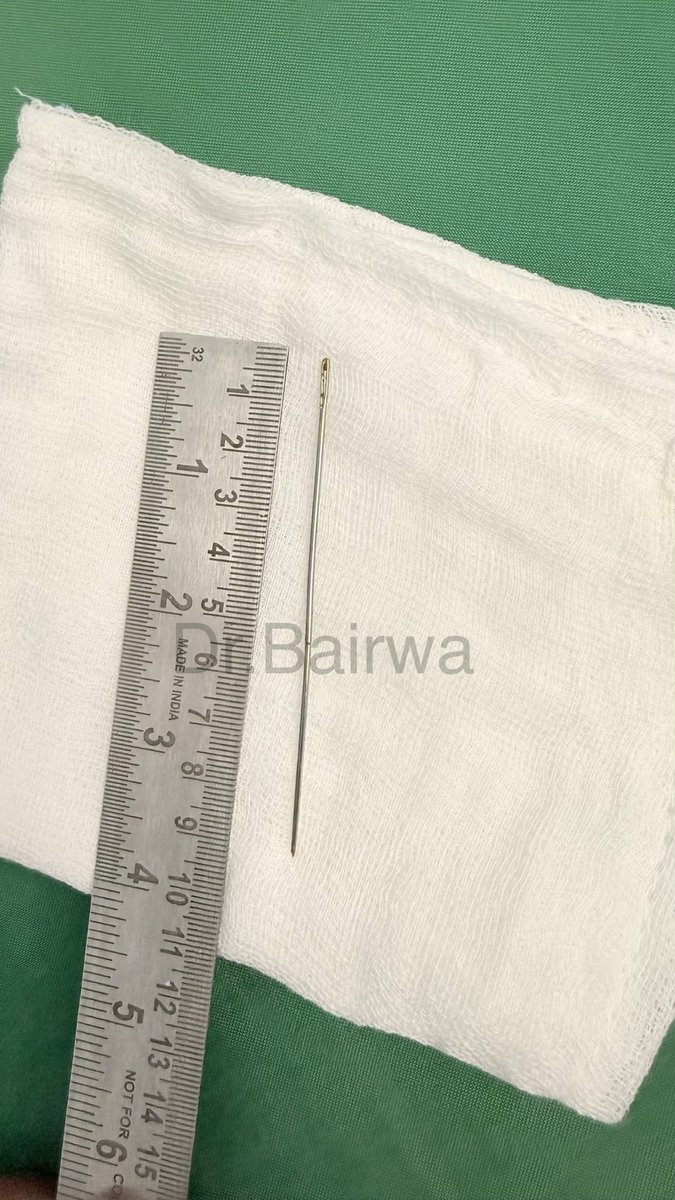 Lap_surgeon's tweet photo. एक विचित्र सा केस!🚨

13 वर्षीय बालक ने अपने घर वालो को बताया कि मैंने कपड़े सिलने वाली सुई निगल ली है, पेट में दर्द हुआ तो मेरे पास ले कर आए। मैंने X ray करवाया तो पता चला के pelvis एक बड़ी कपड़े सिलने वाली सुई है।
सफलता पूर्वक मैंने दूरबीन (Laparoscopy)से निकाला। 

आश्चर्य की बात यह है कि बच्चे ने यह सुई मलद्वार से अंदर डाली है, जो कि जानलेवा हो सकती थी। 
बाद में बच्चे ने क़बूल कर लिया।