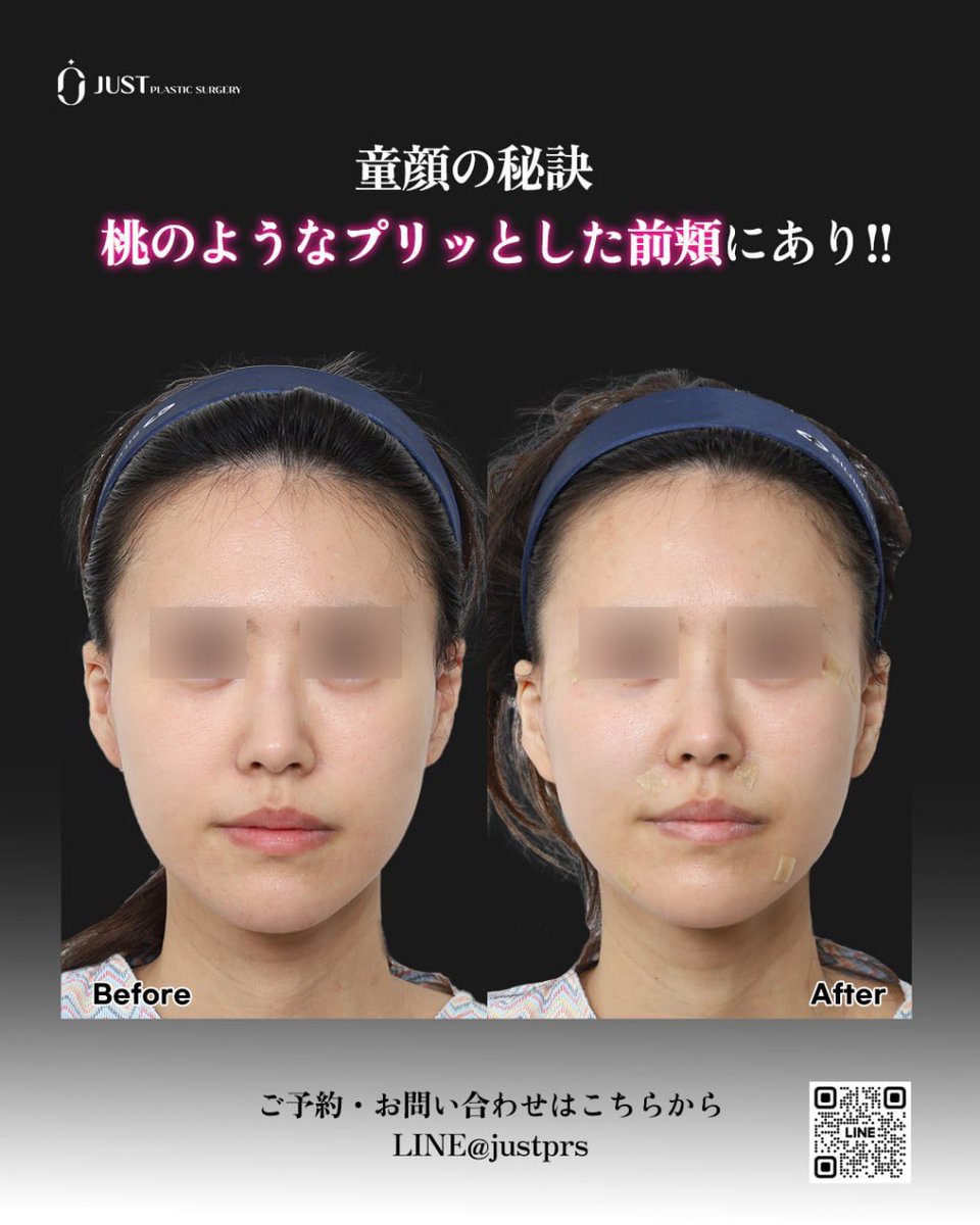 【韓国】糸リフト・目の下脂肪再配置・目整形専門ジャスト美容整形外科 tweet media