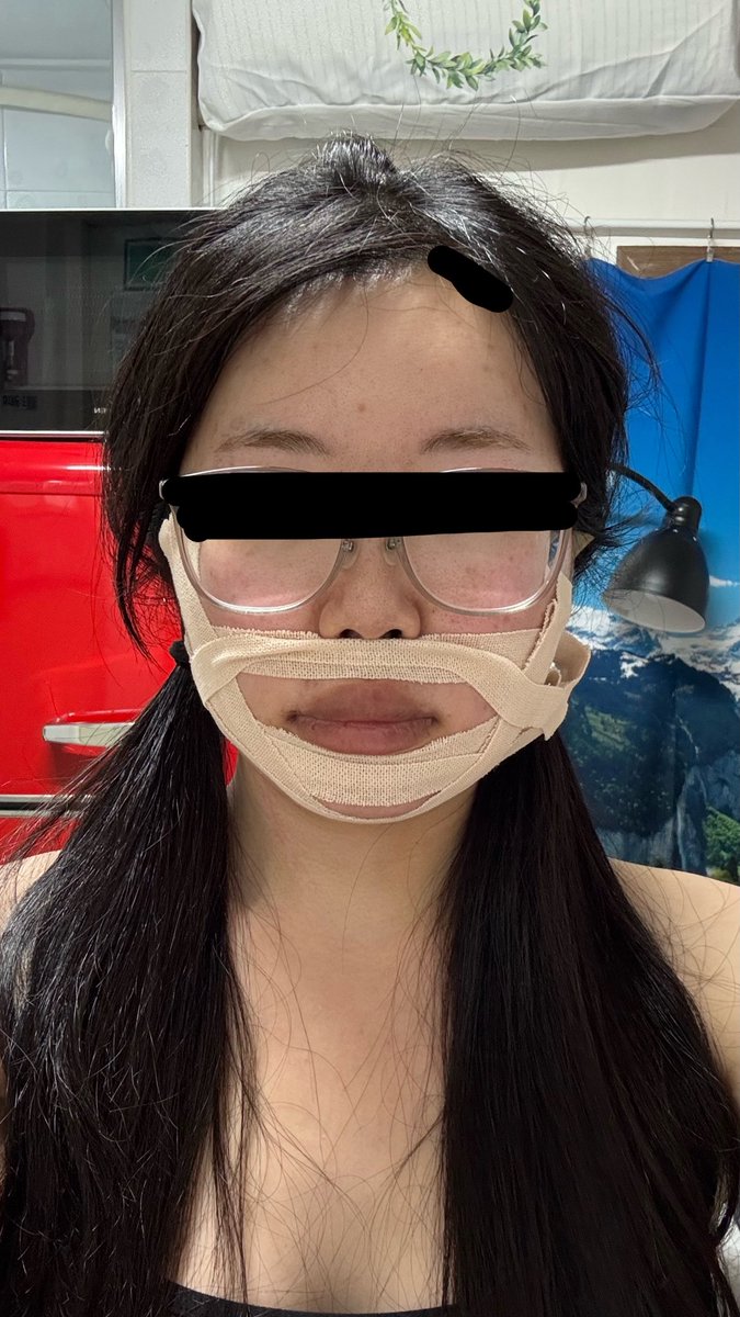 only_ifyouwish's tweet photo. 両顎・輪郭3点レポしていきます！まだ本格的なレポできる気力はないのでとりあえず写真で！
術後すぐ（DT０日目）
DT1日目
DT2日目
DT3日目 https://t.co/rW9bbHljrl