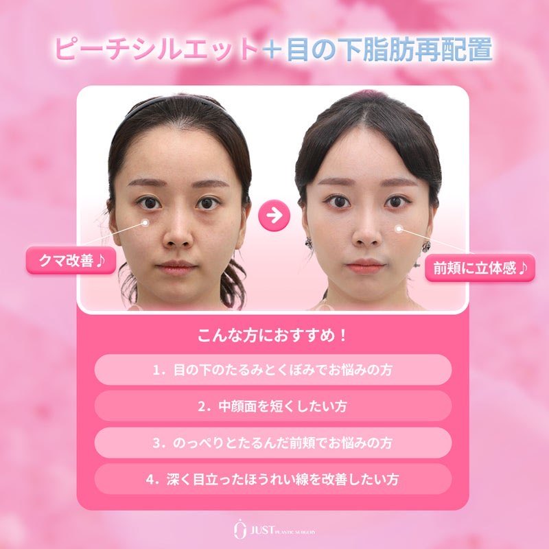 【韓国】糸リフト・目の下脂肪再配置・目整形専門ジャスト美容整形外科 tweet media