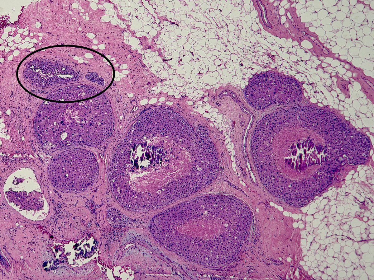 MBBS_Pathology's tweet photo. High grade (pleomorphic) #LCIS with #comedonecrosis & #calcification. #ScreenDetected. Clue in ⭕️ (low grade LCIS). #ECadherin lost.
#pathology
#breastpathology
💚 https://t.co/LnN2xlychi