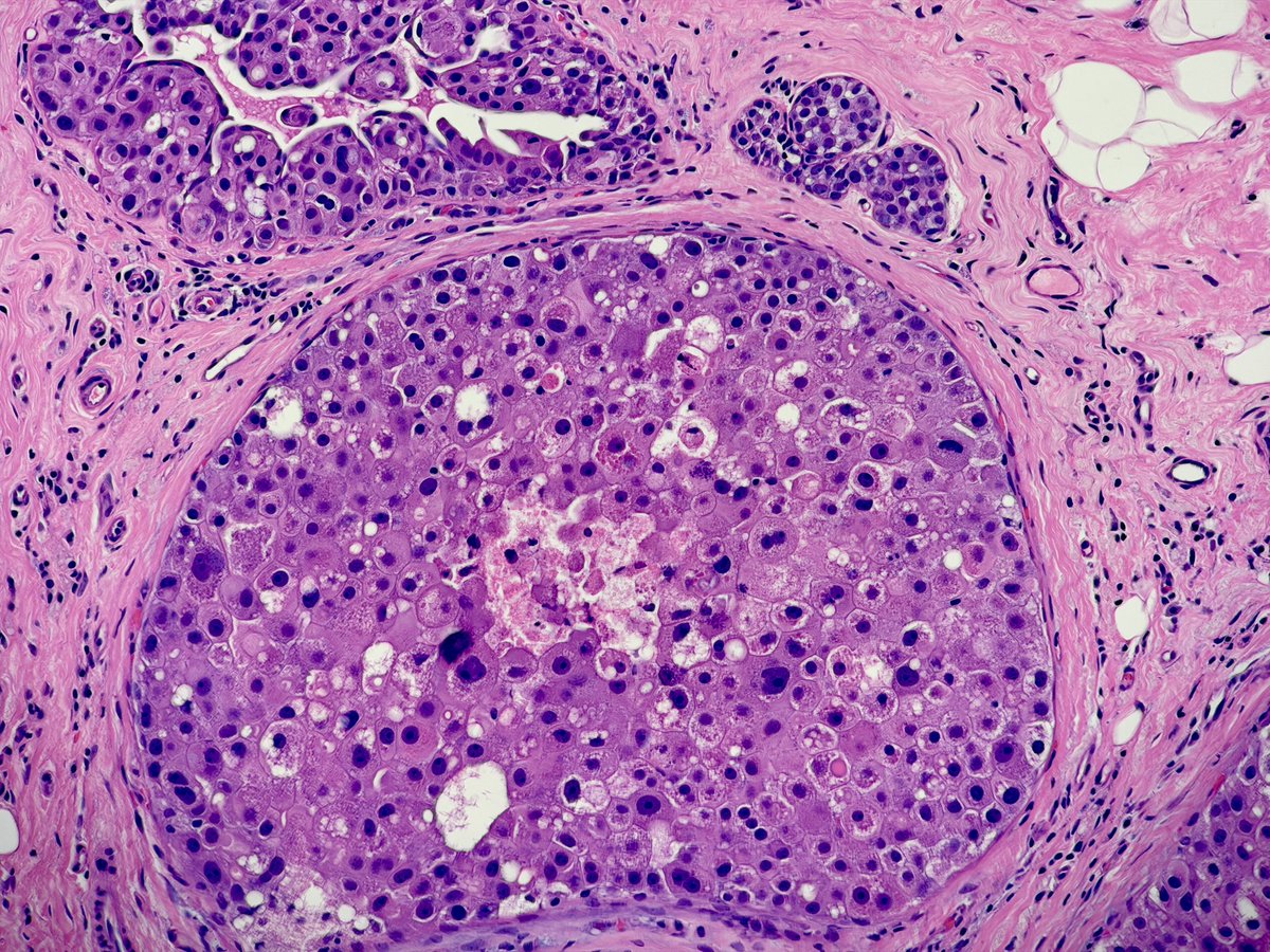 MBBS_Pathology's tweet photo. High grade (pleomorphic) #LCIS with #comedonecrosis & #calcification. #ScreenDetected. Clue in ⭕️ (low grade LCIS). #ECadherin lost.
#pathology
#breastpathology
💚 https://t.co/LnN2xlychi