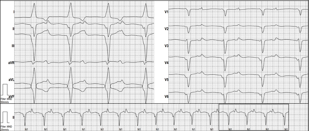 ecgandrhythmRoe's tweet photo. A 60 yo man with chest pain. What do you see? 50 mm/s, rhythm strip 25 mm/s! https://t.co/510Jvfup8k