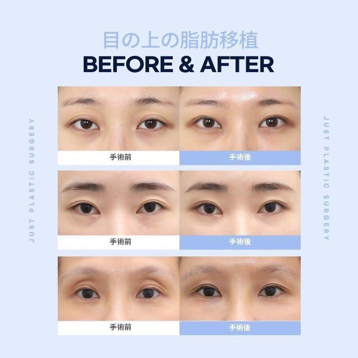 【韓国】糸リフト・目の下脂肪再配置・目整形専門ジャスト美容整形外科 tweet media