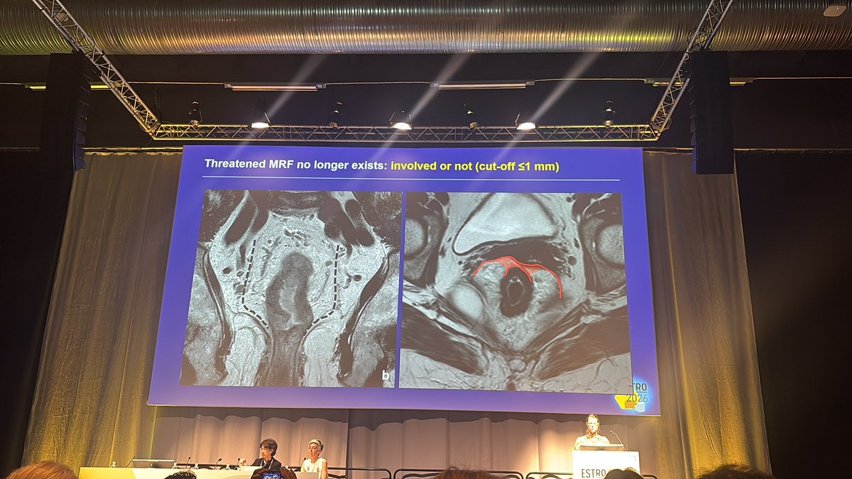 DigestivoSEOR's tweet photo. ESTRO26:  Nuevas guías de estadificacion de Cáncer de RECTO https://t.co/amDYGbh9L3 https://t.co/H6ZtE9jGiV