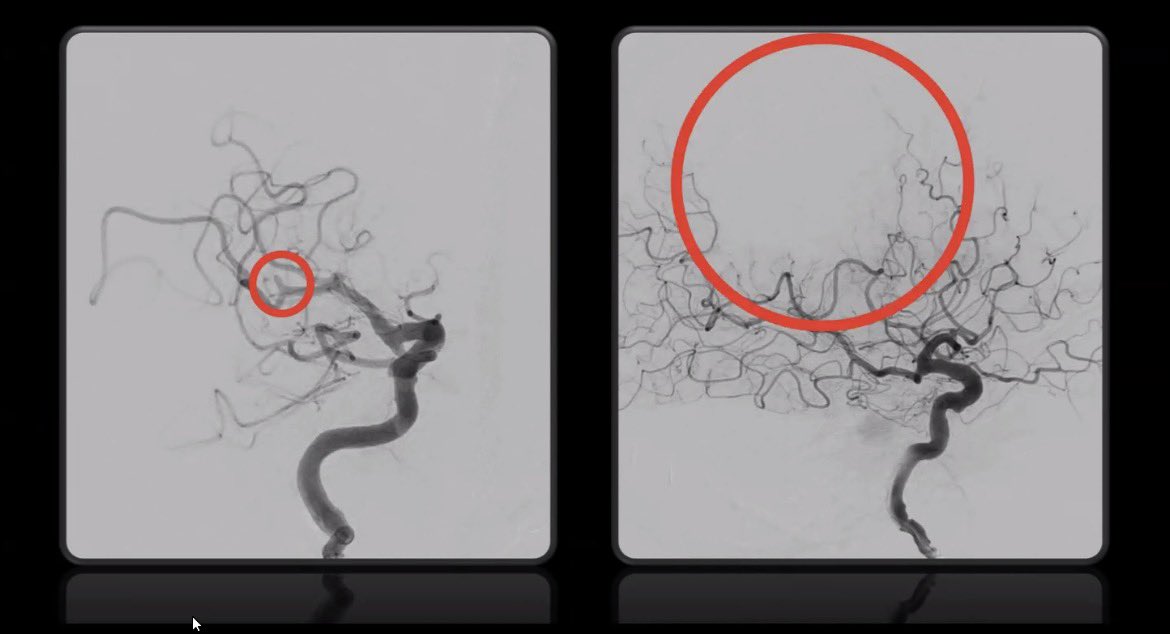 MThrombectomy's tweet photo. 🧠⚡ Dr. Juan Mejia talk challenged the standard of care! 

A compelling real-time cases based discussion on CT perfusion + AI decision support in acute stroke care.

📊 Highlighted use of CTP + AI-based mismatch analysis in real-time EVT decision-making, demonstrating how advanced imaging is increasingly guiding intervention beyond traditional time windows.

🧠 Case featured: 39-year-old patient with ICA dissection
•Presented at ~36 hours from last known well
•Despite delayed arrival, penumbra was still significant on CT perfusion/AI analysis
•Decision made to proceed with mechanical thrombectomy
•Successful ICA reconstruction and reperfusion achieved
 Even in ultra-late presentations, physiology (penumbra viability) can override time, enabling meaningful intervention in selected patients.

#Stroke #Thrombectomy #CTPerfusion #AIinMedicine #Neurology #Endovascular #MissionThrombectomy