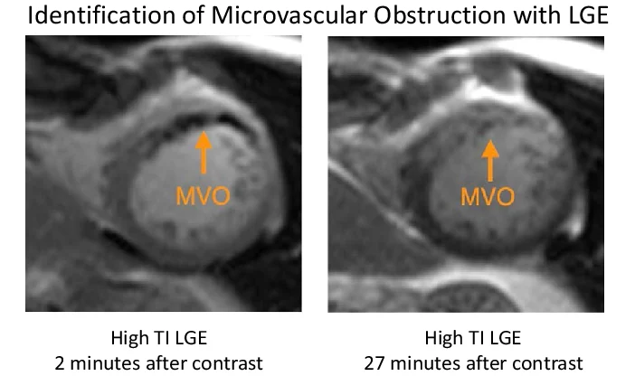 RitikaTuliMD's tweet photo. #CardioNuggets™

Microvascular obstruction (MVO) 

After a STEMI, restoring epicardial flow with PCI doesn’t always mean true myocardial reperfusion. In >40% of reperfused MIs, the downstream coronary microcirculation is damaged/plugged by:

• distal embolization of thrombus/plaque
• endothelial swelling
• inflammation & edema
• capillary destruction

➡️ Result: blood can’t adequately enter the infarcted myocardium despite a patent epicardial artery (“no-reflow phenomenon”).

Why it matters:
MVO is a marker of severe reperfusion injury and predicts:
• larger infarct size
• adverse LV remodeling
• lower EF recovery
• HF admissions
• ventricular arrhythmias
• higher mortality

How is it diagnosed?
🩺 Angio clues: slow/no-reflow despite open vessel (↓TIMI myocardial perfusion grade)
🫀 Echo: poor myocardial contrast replenishment on myocardial contrast echo
📍Gold standard = Cardiac MRI
• seen as a dark hypoenhanced core within bright late gadolinium enhancement infarcted tissue
• early MVO = first-pass perfusion defect
• late MVO = persistent dark core on LGE images

High-yield pearl:
A patient can have TIMI 3 flow after PCI and still have major myocardial injury because the microvasculature never truly reperfused. 

#CardioNugget #MedEd

Image source: https://t.co/vcgvUTP00s