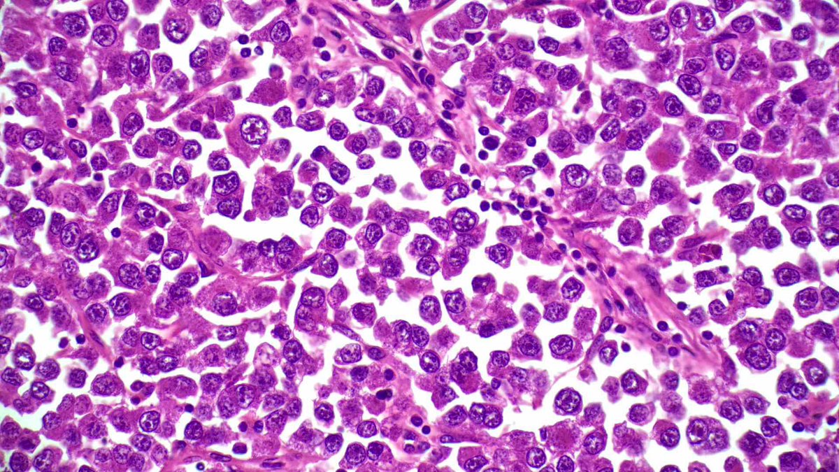 AMontasserMD's tweet photo. S E M I N O M A

#Pathology #GUpath #PathTwitter #PathX #Classic 🔬