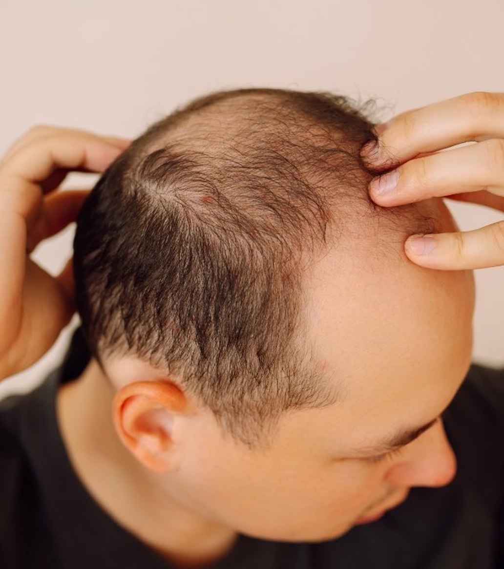 MathebulaEdwin1's tweet photo. 🇪🇸 Spain ranks as the world's baldest country, with over 44% of men having male pattern baldness.

@BRICSNews https://t.co/E59tN7HRiY