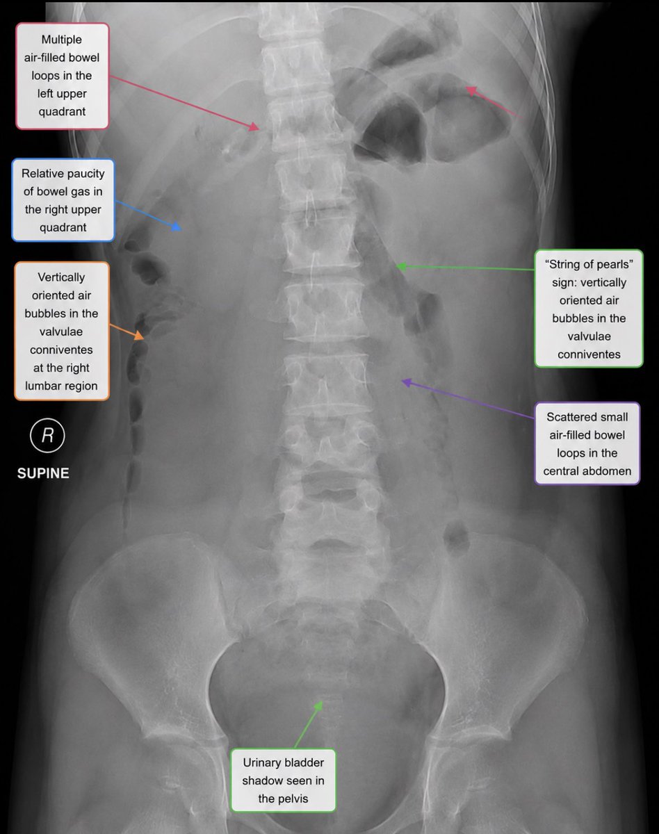 🚨 AXR breakdown 🩻 🔻Notice the tiny vertically aligned air bubbles along ...