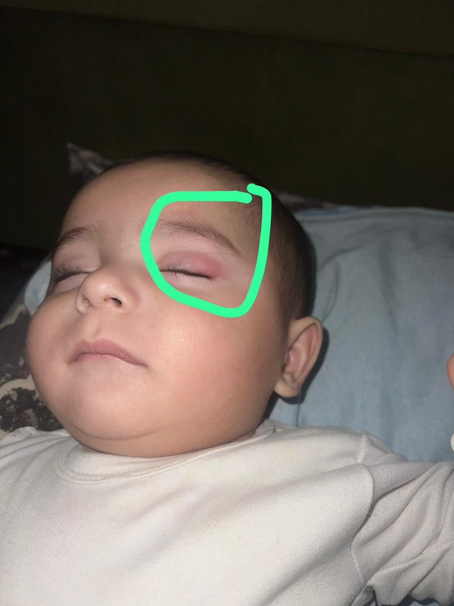 Kat_Zoe's tweet photo. 🇵🇸 Baby Imad is in pain 🇵🇸

He’s being bitten by bugs at night

Hit tent is full of holes, offering him no safety and protection

https://t.co/X29URQ0O1F

Support his father (@mad05999) https://t.co/n19aUVDvaG