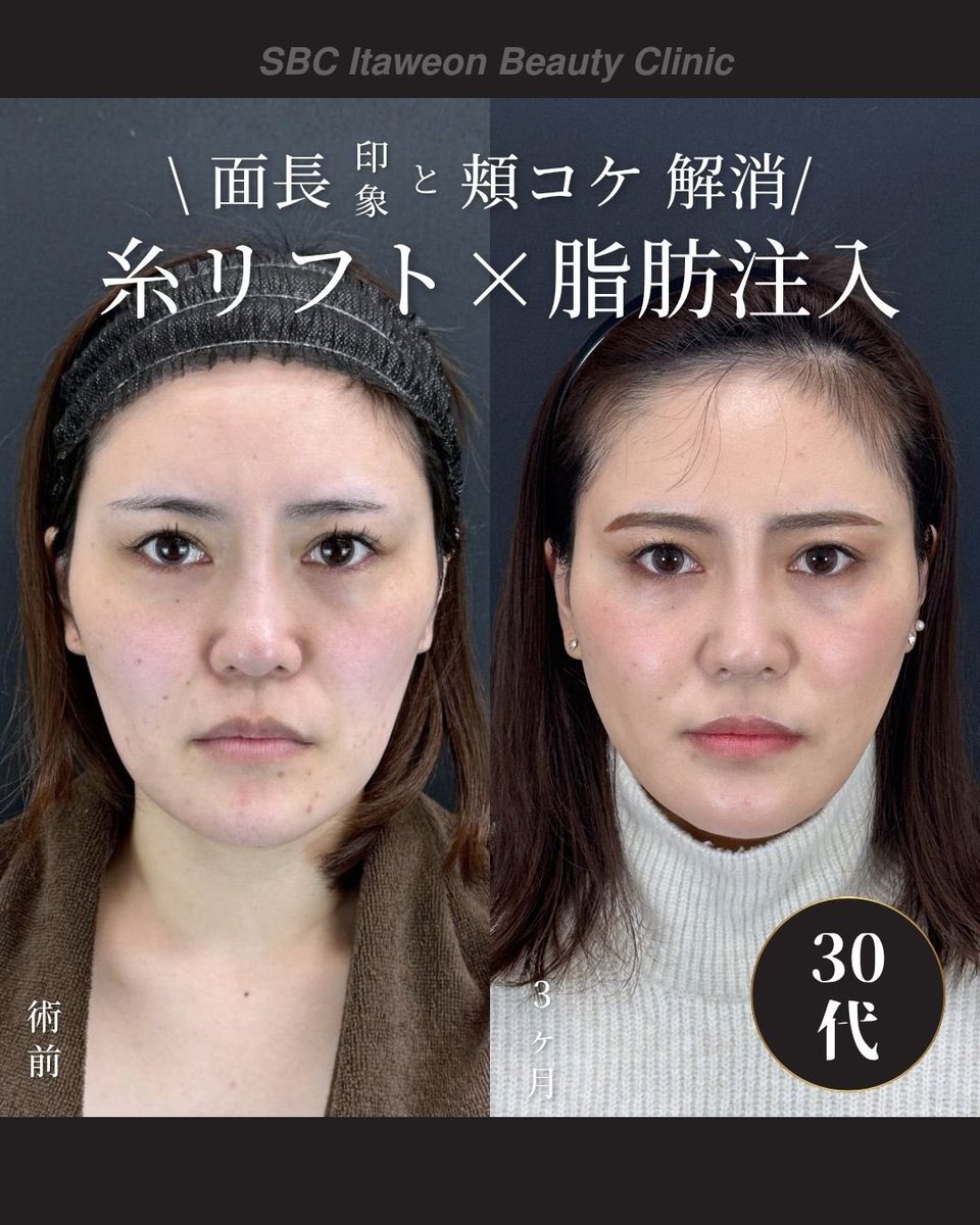 小顔輪郭整形 | 小顔KING(濱田純) / イテウォン名古屋栄院 tweet media