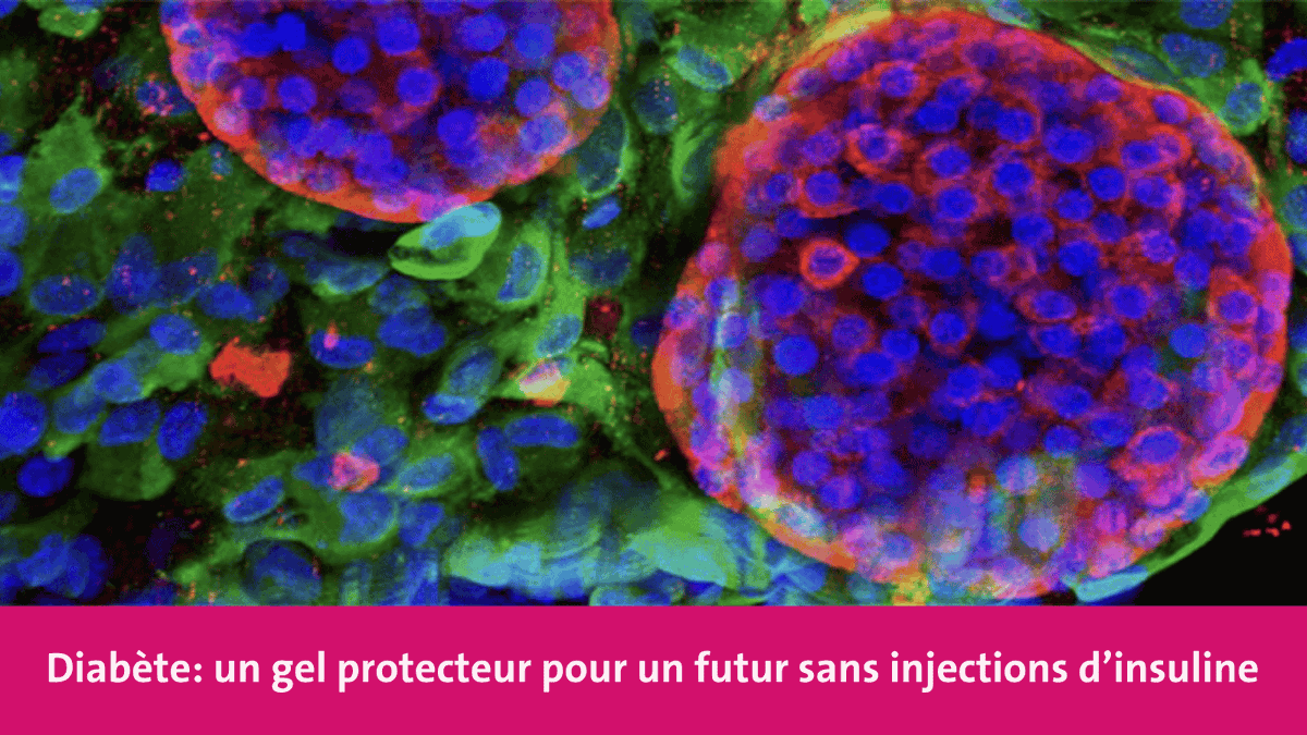 UNIGEnews's tweet photo. Grâce à un hydrogel innovant, une équipe de l’#UNIGE et des @hug_ge dirigée par @Eka_Berishvili fait une avancée importante pour le développement d’un pancréas bioartificiel. Il permettrait aux patient-es diabétiques de se passer d'injections d'insuline. https://t.co/fhSs6eidrw https://t.co/nli8Y3Qm9S