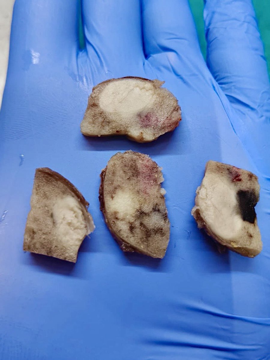 megha_lalcheta's tweet photo. 25 years female, Hemithyroidectomy specimen, normal TFT values
#EndoPath
#PathX #Pathresidents #Pathology #Pathtwitter #Surgpath #Thyroid # https://t.co/9lDwdc01F2