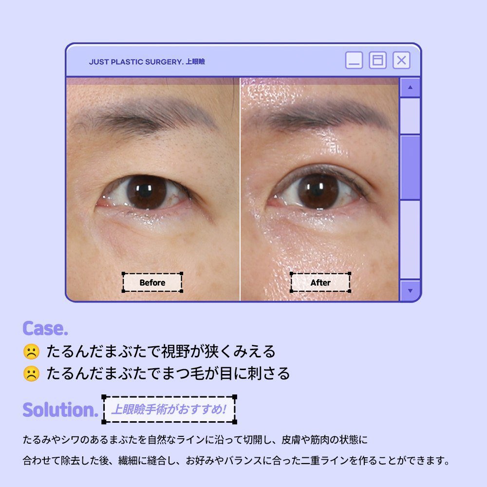 【韓国】糸リフト・目の下脂肪再配置・目整形専門ジャスト美容整形外科 tweet media