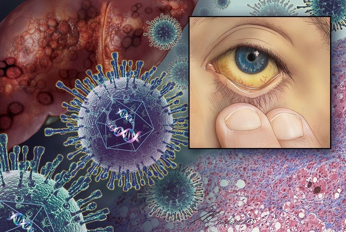 DirIllustration's tweet photo. Medical illustrator Michele Graham transforms complex clinical concepts into compelling visual storytelling in this recent piece for Family Practice Essentials.

Focused around the unmistakable yellowing of a jaundiced eye, the illustration layers together a diseased liver, microscopic imagery of fatty liver disease, and cascading hepatitis C viruses to reveal the interconnected effects of liver pathology. Thoughtfully composed and rich in educational detail, the piece demonstrates how medical illustration can bridge science, diagnosis, and patient understanding through a single image.

Explore more of her medical illustrations on the Directory of Illustration: https://t.co/fFuRBwdpol 

#medicalillustration #scientificvisualization #hepatitisc #liverdisease #fattyliverdisease #pathology #medicaleducation #patienteducation #visualscience #biomedicalart