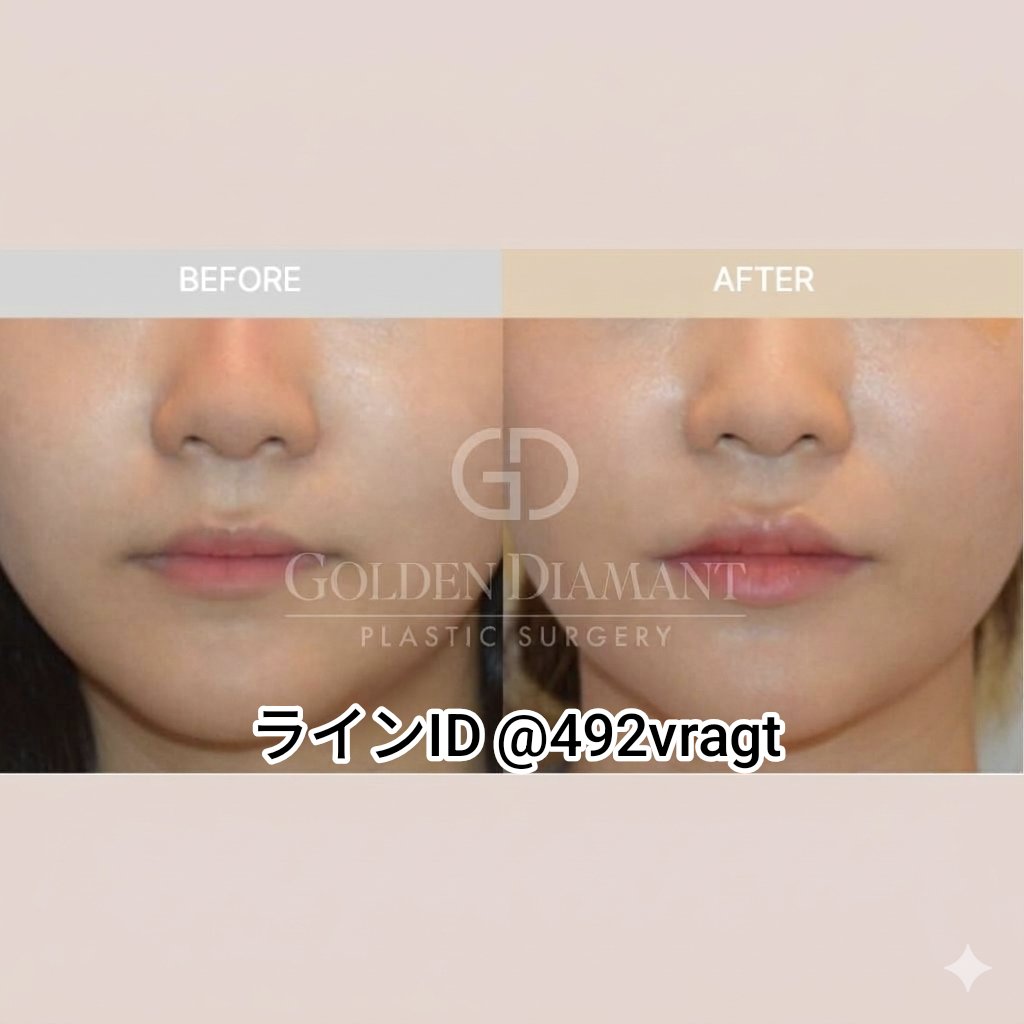 goldendiamantps's tweet photo. ゴールデンディアマントの人中縮小が上品に見える理由

従来のように皮膚だけを整えるのではなく、 深層の口輪筋まで丁寧に引き上げて固定することで、 内側から支えるようにデザインします
そのため術後の後戻りが起こりにくく、上唇のラインも自然に整いやわらかく洗練された印象に仕上がります https://t.co/tynUaZbjrY