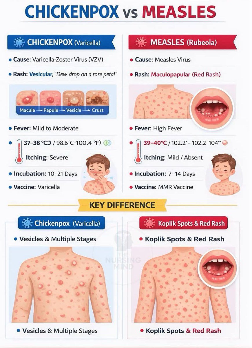Sir_Ousman's tweet photo. Chickenpox Vs Measles

Chickenpox and measles are both viral rashes, but differ in rash type (blisters vs. flat spots).

Initial symptoms:
chickenpox often starts mild fever. tiredness

measles with high fever, cough, runny nose, red eyes.

Spread: 
Chickenpox = rash spreads all over, 
measles = rashes spreads from face down

Severity:
Measles generally more dangerous.

 Key differences: 
Chickenpox has itchy, fluid-filled blisters in different stages.

Measles has flat, red, blotchy patches, starts on the face, and includes respiratory symptoms like cough/conjunctivitis, with potential for serious complications like pneumonia or encephalitis